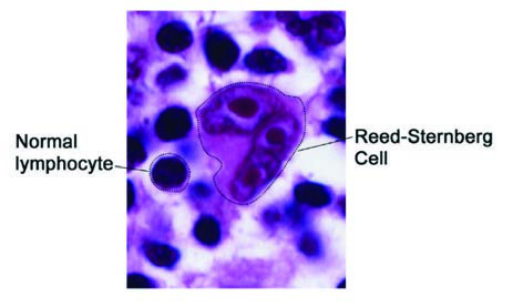 Reed-Sternberg Hücresi — resim 4