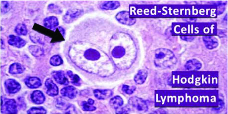 Reed-Sternberg Hücresi — resim 5