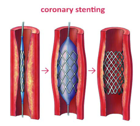 Stent — resim 3