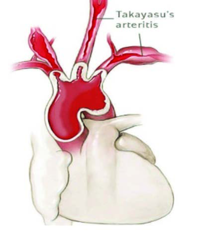 Takayasu Arteriti — resim 2