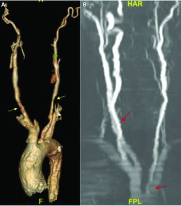 Takayasu Arteriti — resim 3
