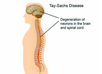 Tay-Sachs Hastalığı — resim 3