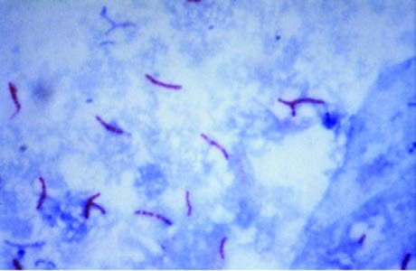 Ziehl–Neelsen stain boyama ile Mycobacterium  tuberculosis bakterilerinin görüntüsü.