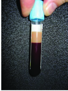 Hipertrigliseridemi