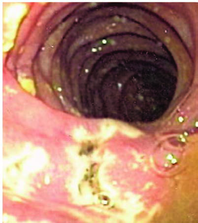 Gastrinoma (Zollinger-Ellison sendromu) olan bir hastada  distal duodenumda yer alan çok sayıda küçük ülserin endoskopik  görüntüsü.
